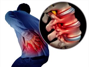 How to prevent lumbar disc herniation? Complete analysis of daily posture and exercise!