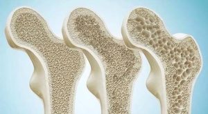 Osteoporosis prevention: Calcium supplementation, vitamin D, and exercise are all essential!