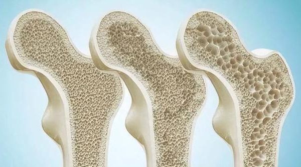Osteoporosis prevention: Calcium supplementation, vitamin D, and exercise are all essential!